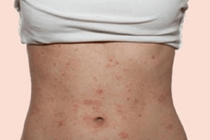 Xử Trí Như Thế Nào Khi Sử Dụng Máy Massage Bụng Bị Ngứa?